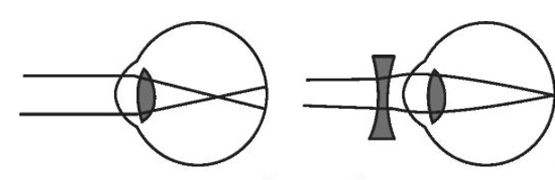 Изображение в близоруком глазу. Близорукость схема глаза. Глаз при миопии схема. Оптическая система глаза при близорукости. Схема дальнозоркости и близорукости физика.
