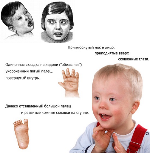 Синдром Шерешевского - Тернера